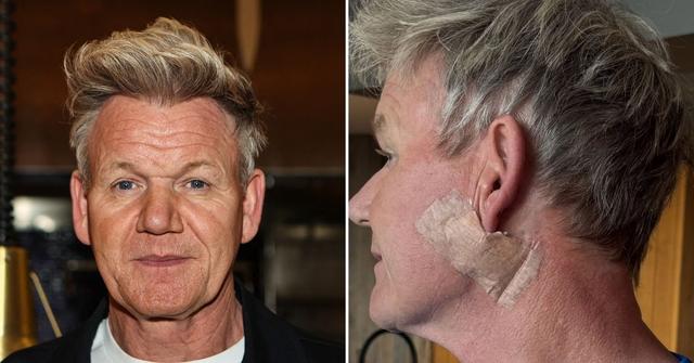Gordon Ramsay Reveals Skin Cancer Scare, Had Surgery