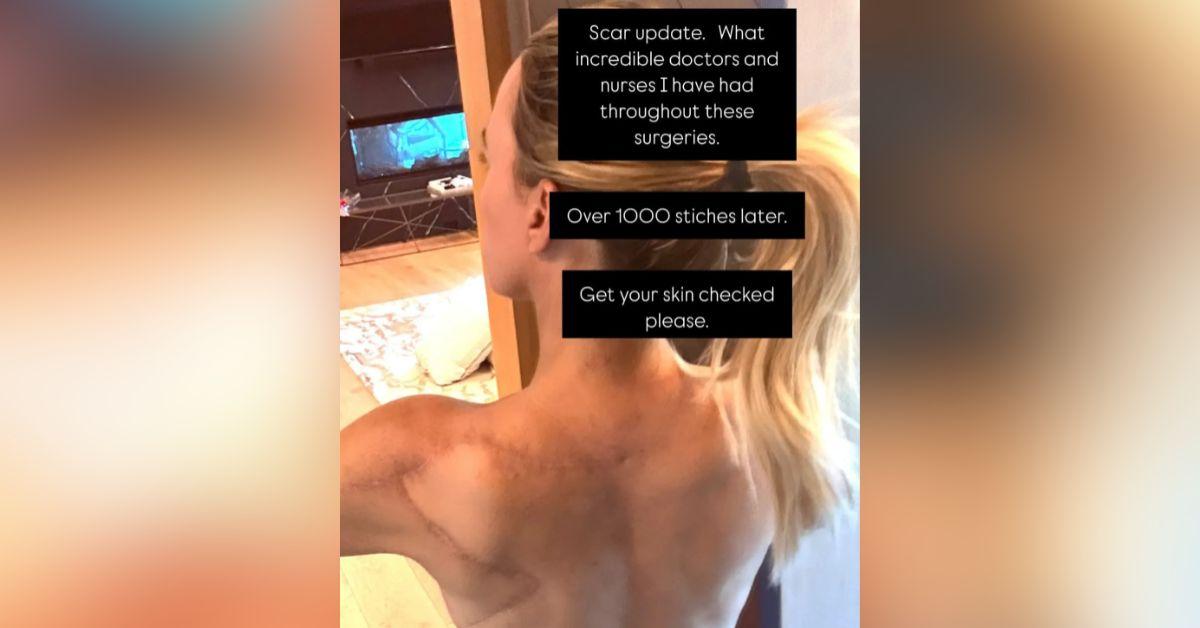 teddi mellencamp post surgery