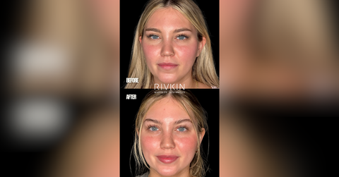 love island star hannah fields stuns fans with fresh new look after rivkin aesthetics filler transformation