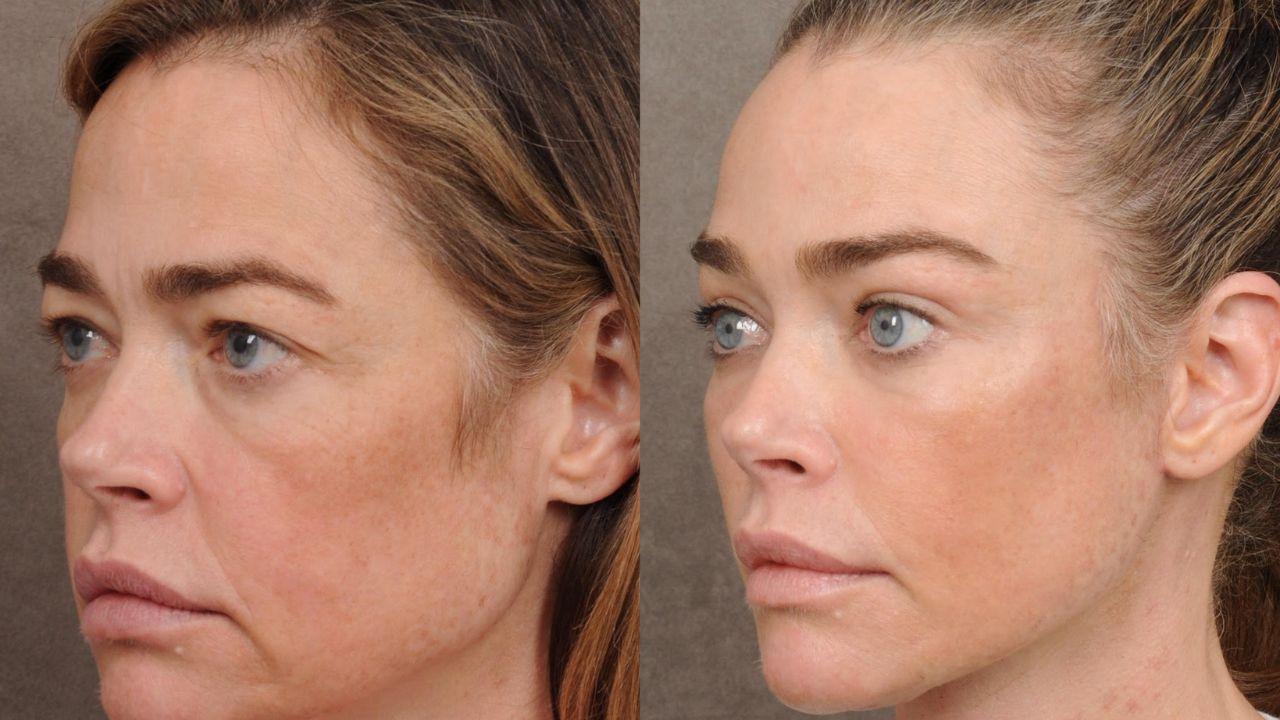Image of Denise Richards said she is ultimately happy with her choice to get treatments done on her face despite the pain she had to encounter.