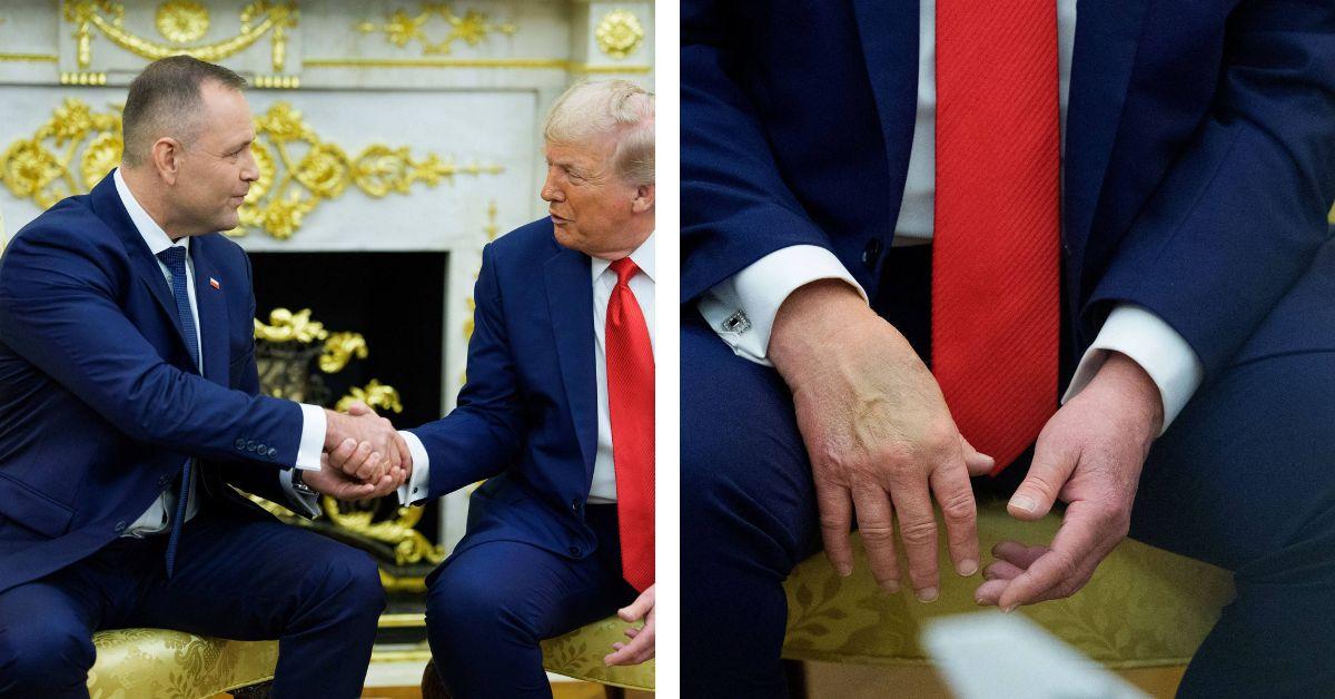 image of The president has been spotted with bruises on his hands for months.