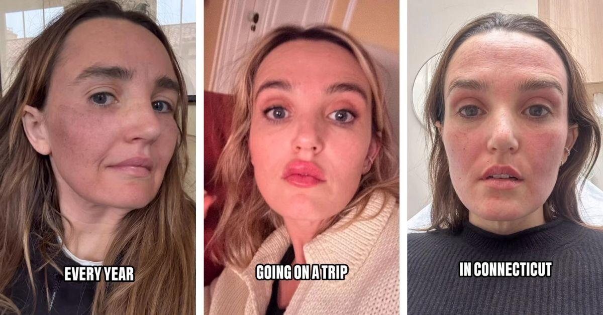 image of Chloe Fineman shared unfiltered photos of her bruised and swollen face after med spa treatments.