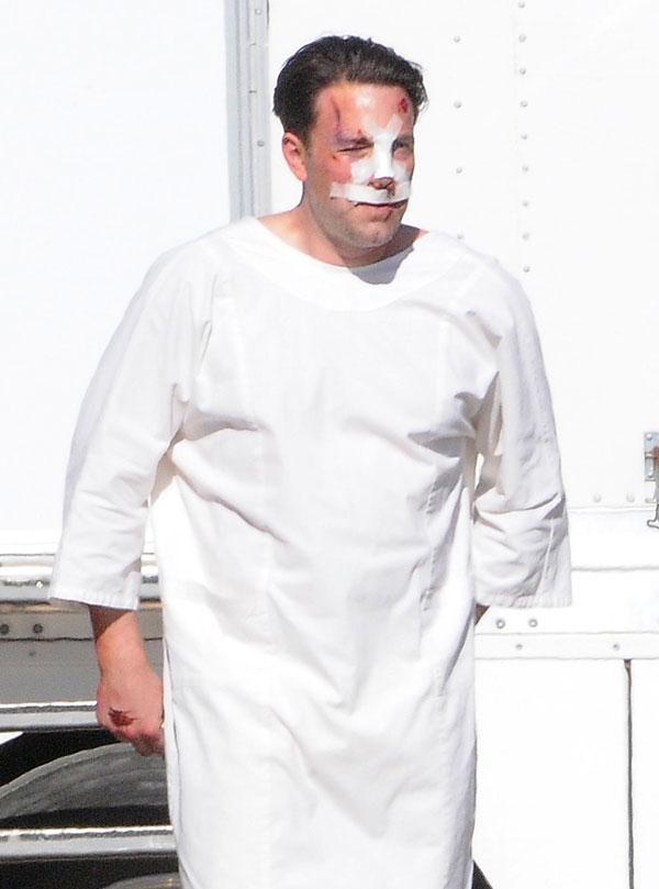 Ben Affleck Plastic Surgery Bruises