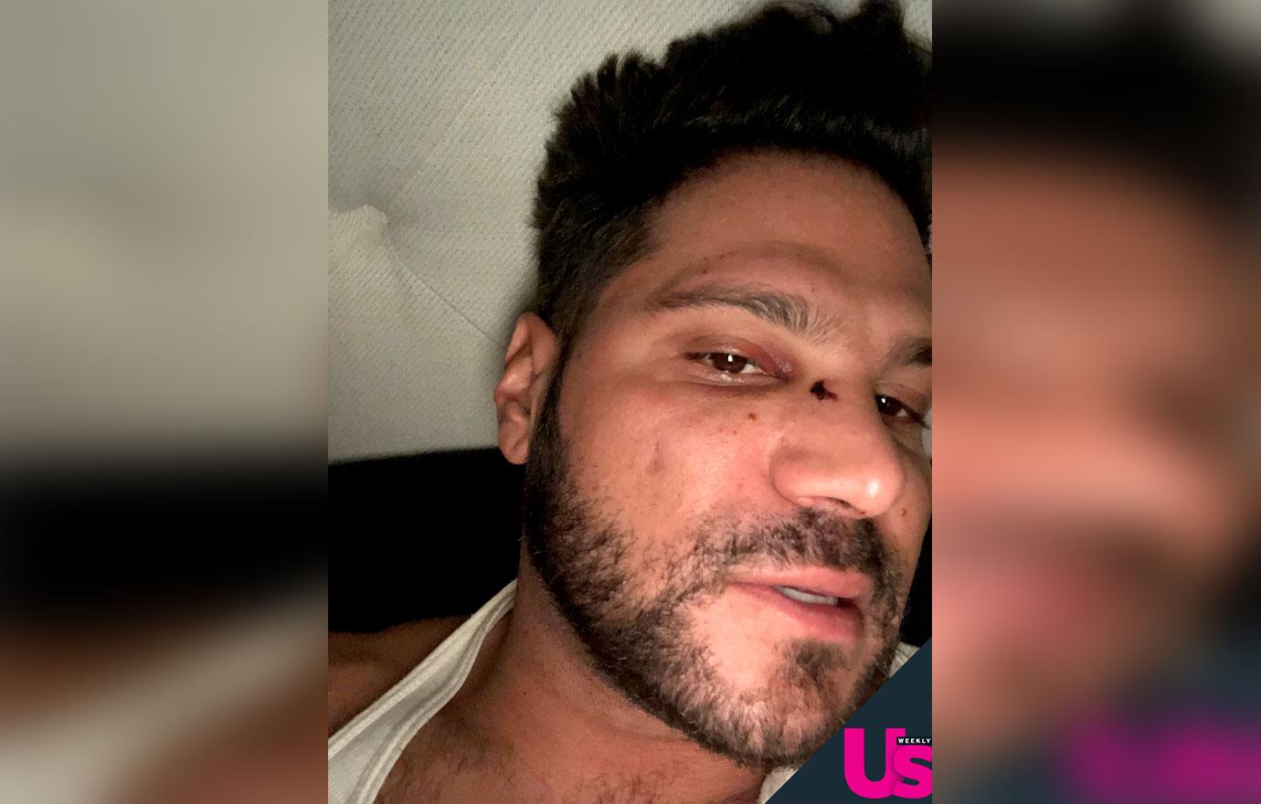 Gruesome Pics Ronnie OrtizMagro’s Face After Alleged Jen Harley Fight(00)