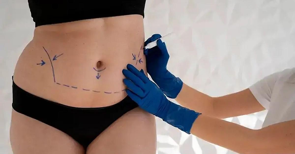 liposuction in the abdominal area pp