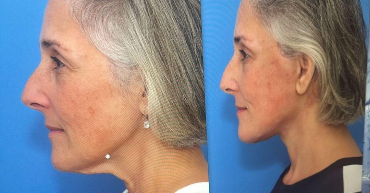 ricki lake reveals before and after results facelift  pound weight loss photo