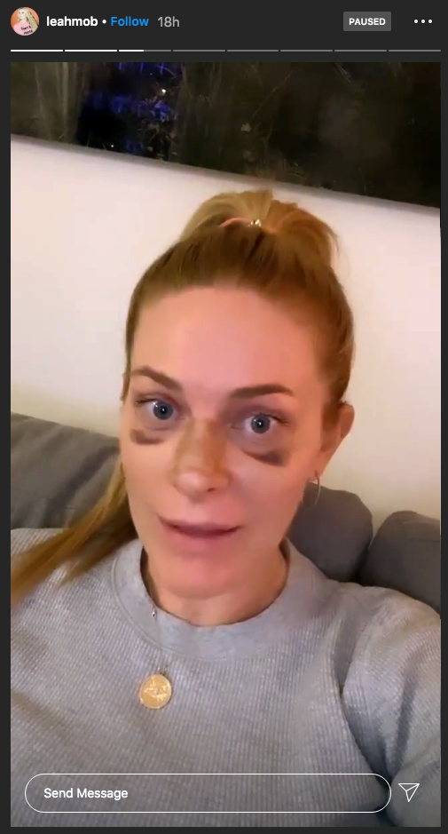 'RHONY' Star Leah McSweeney Admits To Getting A Nose Job