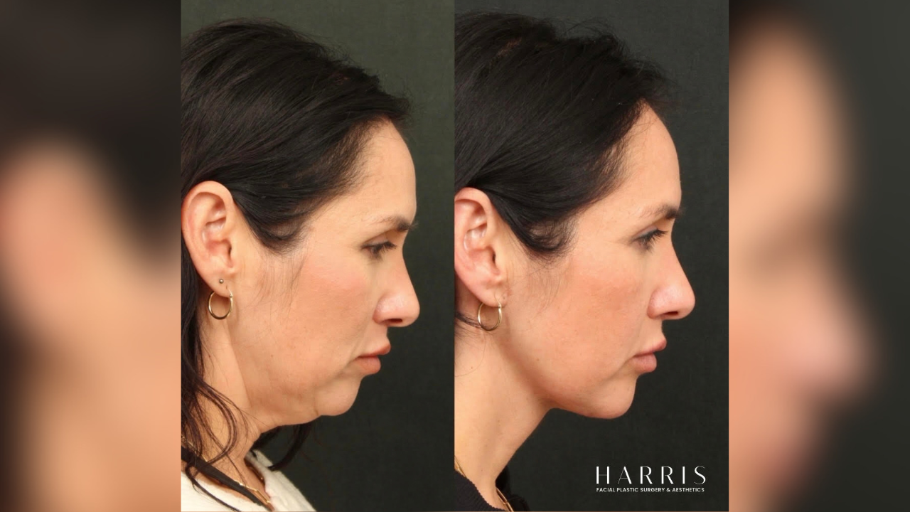 beverly hills surgeon dr william c harris wants patients to look like themselves
