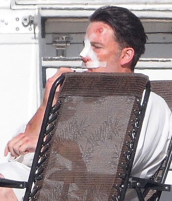 Ben Affleck Plastic Surgery Bruises