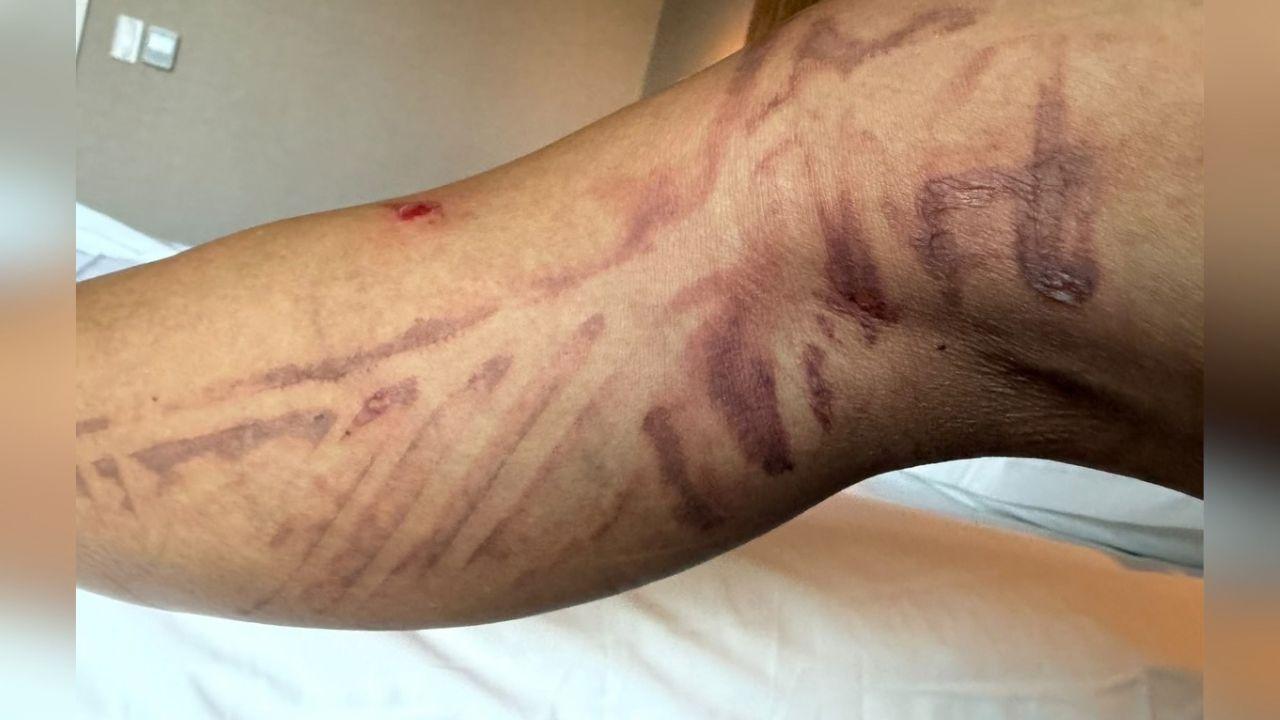image of The singer suffered the injury on September 26 after boiling water spilled onto her leg about an hour before a Pussycat Dolls performance in Düsseldorf.