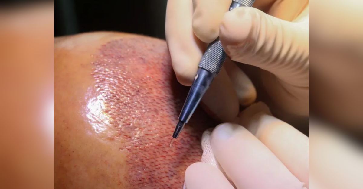 top best hair transplant turkey istanbul