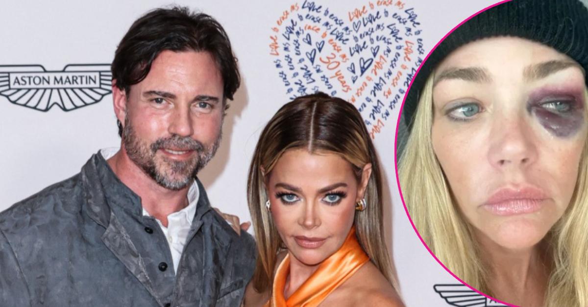 Photo of Aaron Phypers and Denise Richards; picture of Denise Richards' black eye.