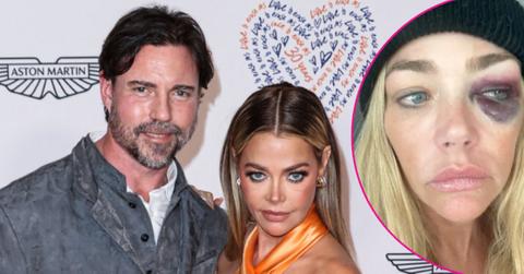 Photo of Aaron Phypers and Denise Richards; picture of Denise Richards' black eye.