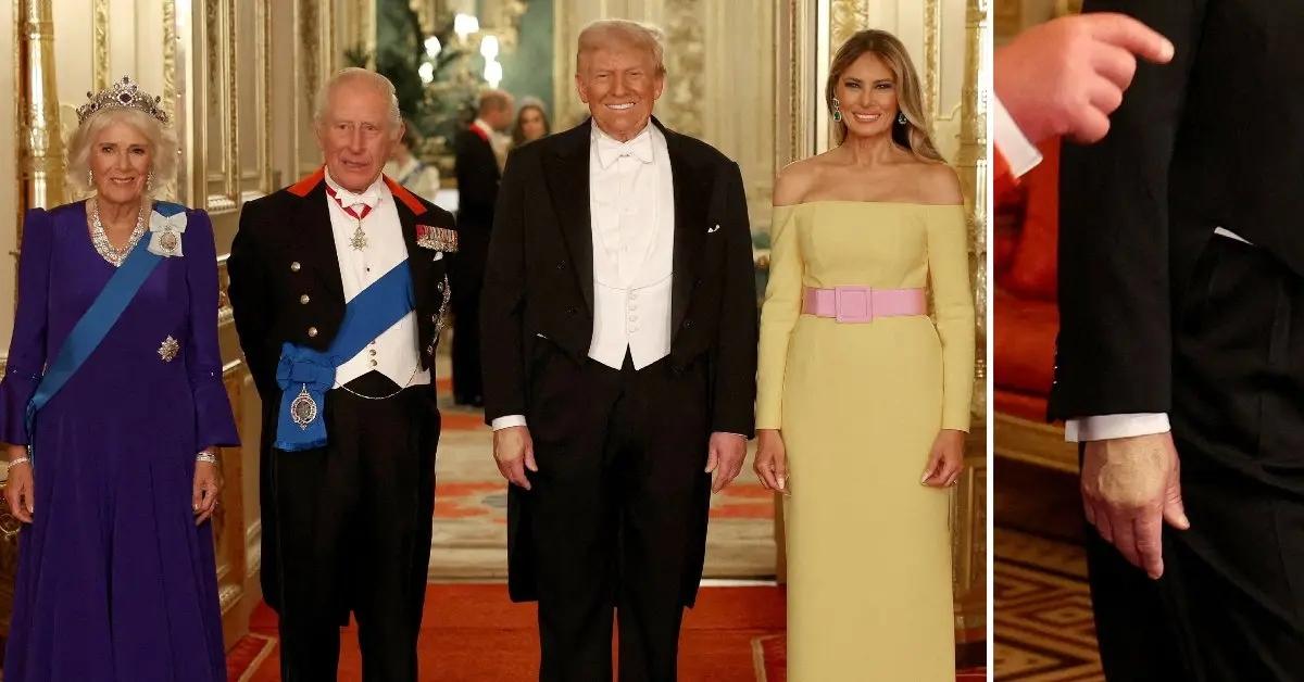 Photo of In July, it was revealed that the POTUS was diagnosed with chronic venous insufficiency.