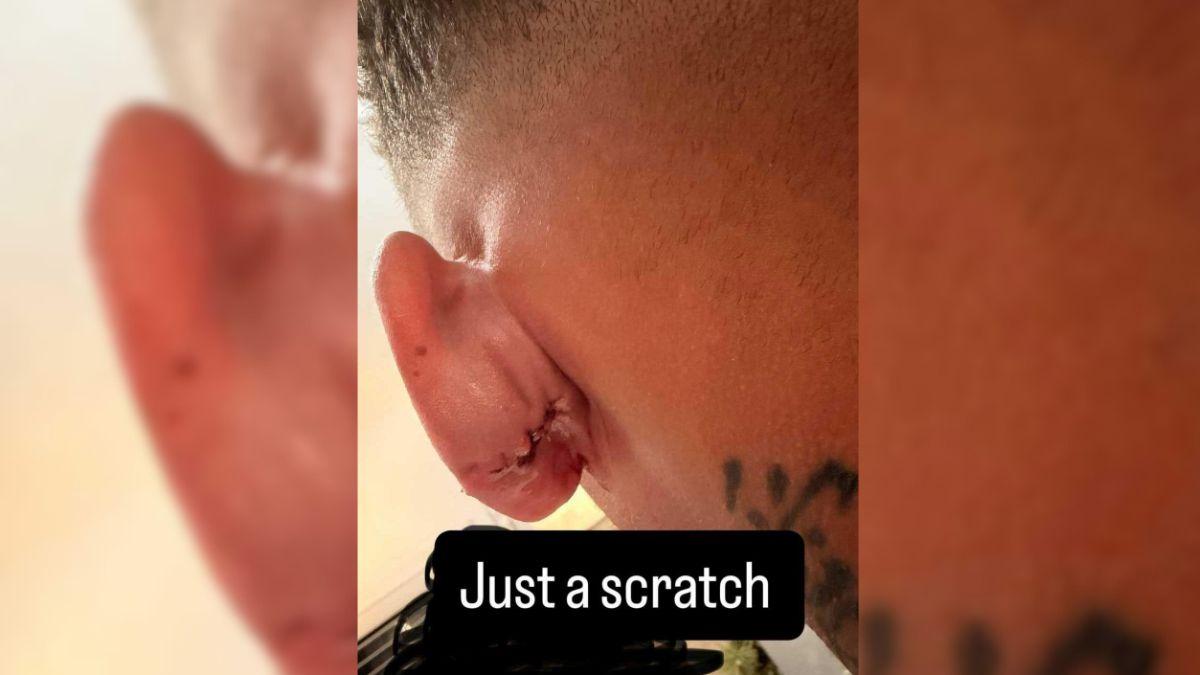 Image of Kane Brown shared that the golf ball that hit him was flying at a speed of 150-180 miles per hour.