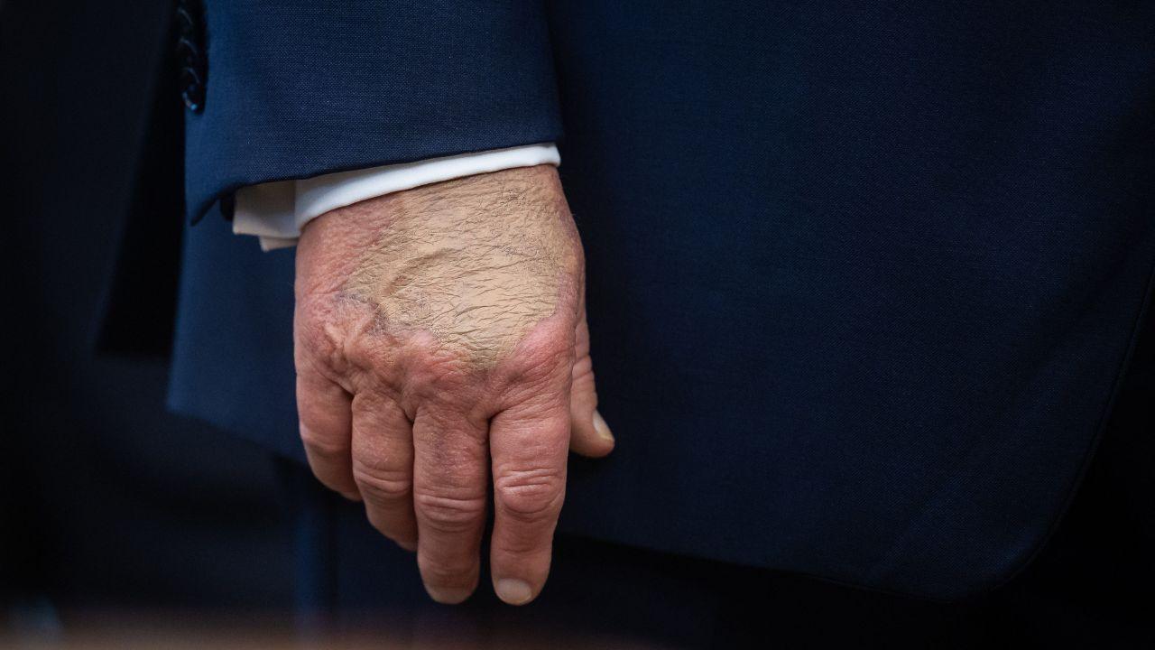 Photo of Trump has displayed numerous physical ailments.
