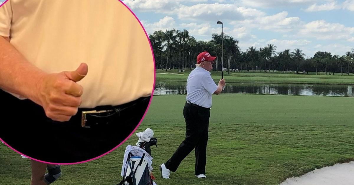 Donald Trump's Bandages and Bruises Spark Health&hellip;