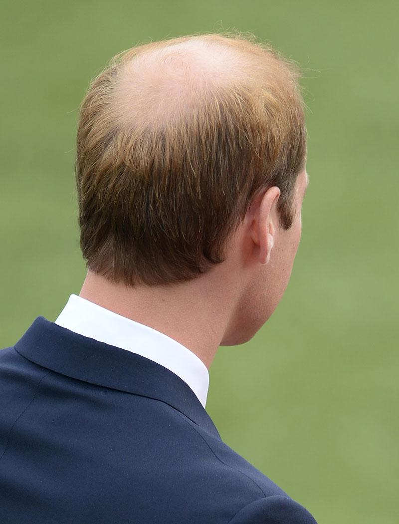 Prince william balding 02