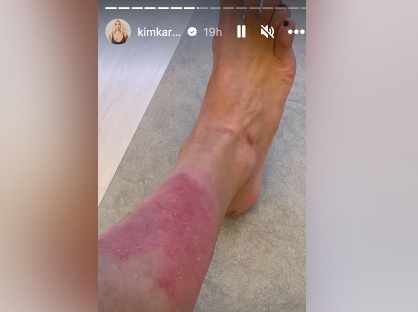 kim kardashian shows crazy painful struggle psoriasis