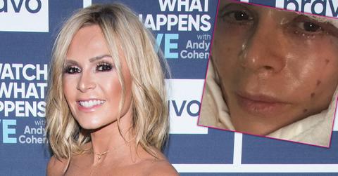 Tamra Judge Face Lift Plastic Surgery Photos Long