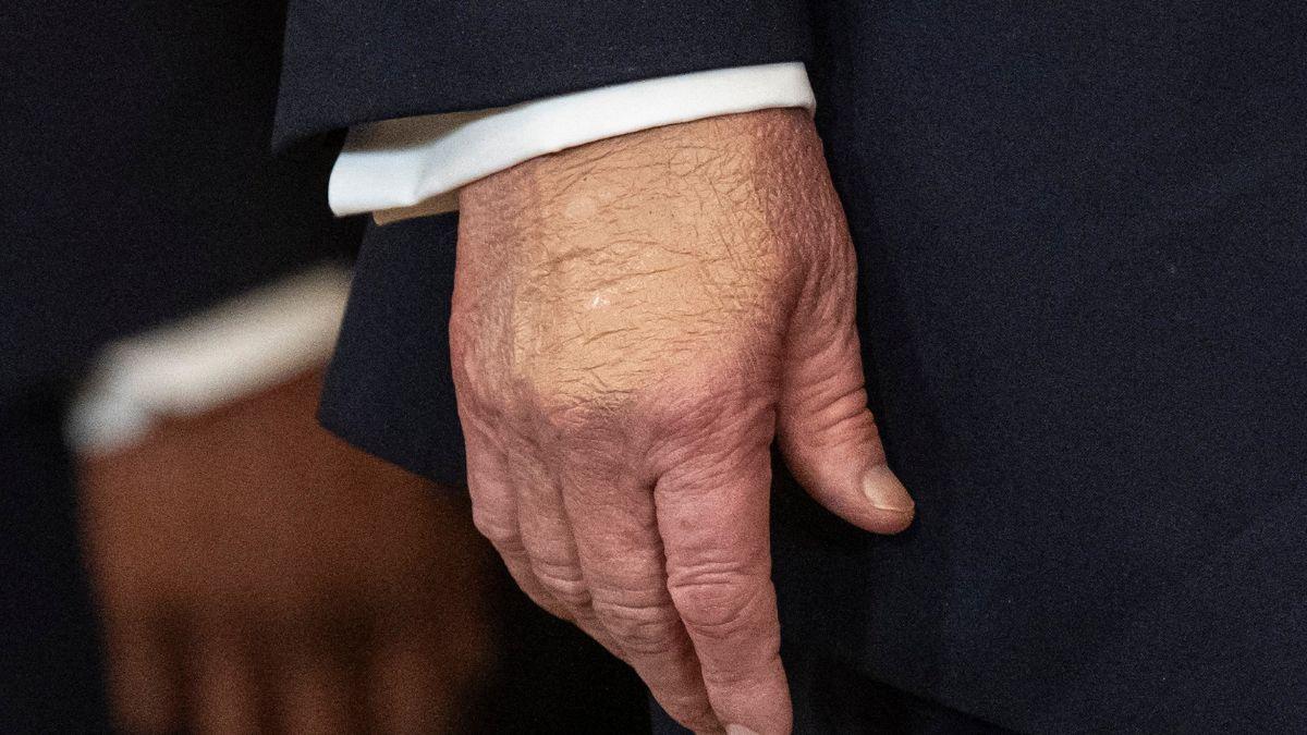 Image of Donald Trump's bruised hands and swollen ankles frequently fuel health concerns.
