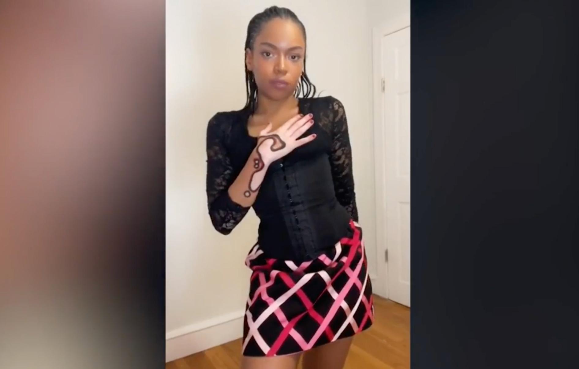 rhode island woman uses her vitiligo spots