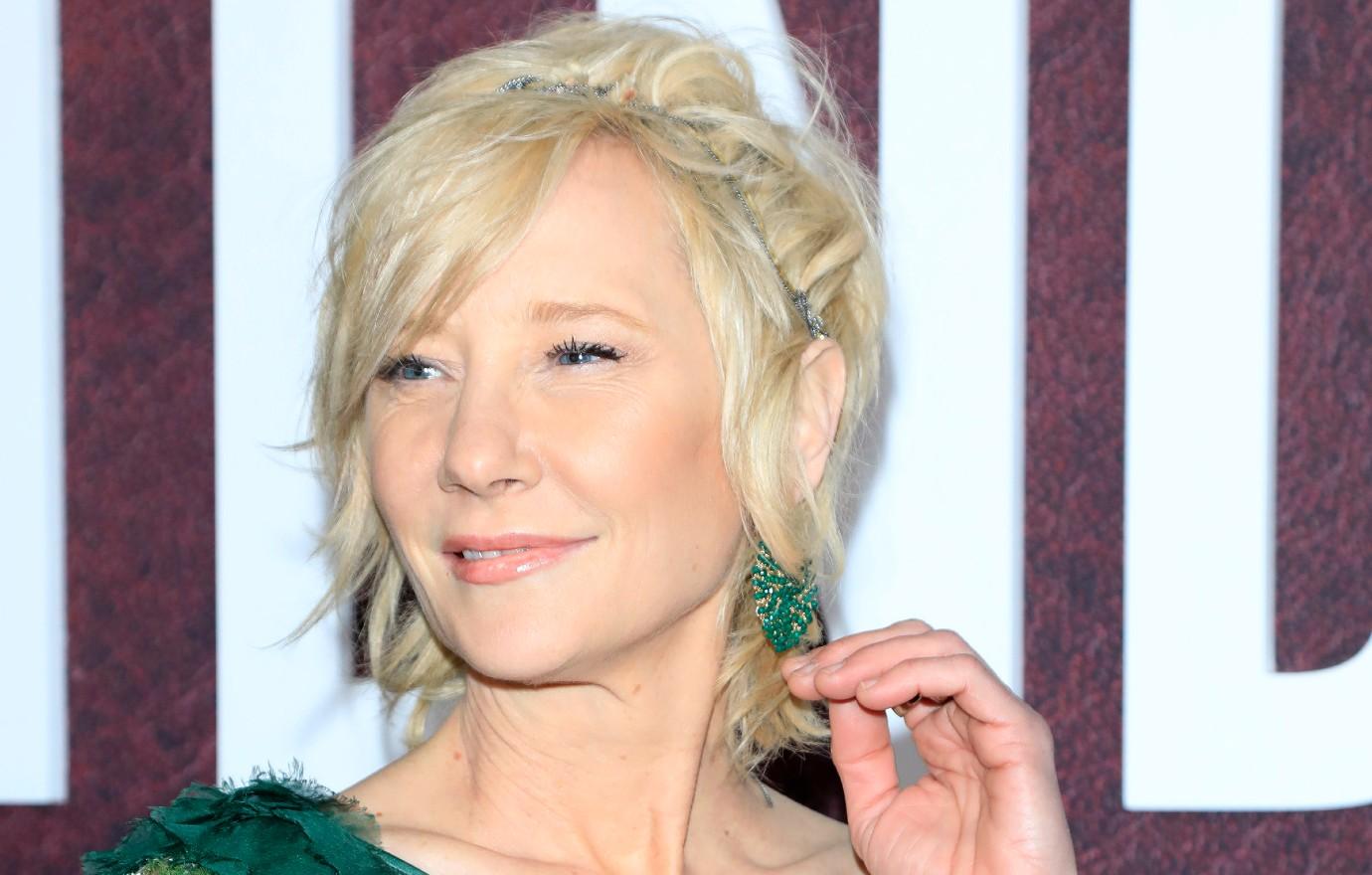 anne heche hospitalized severe burns fiery car crash