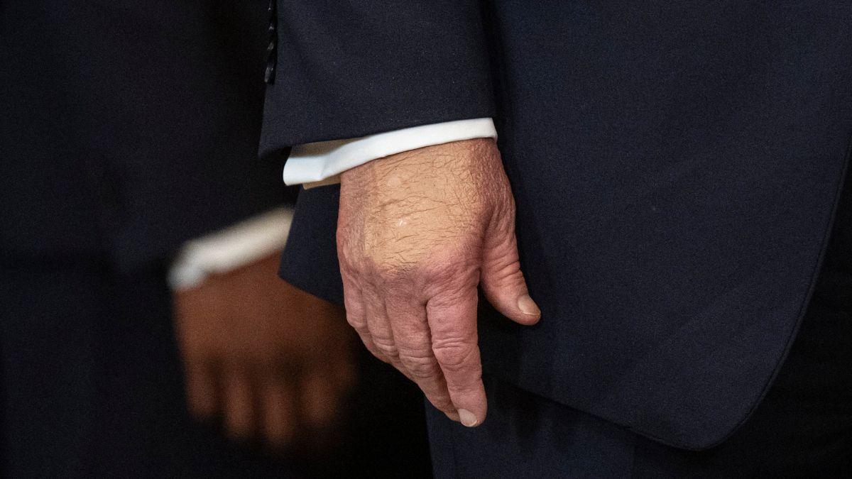 Image of Donald Trump is often spotted hiding bruising on his hands.