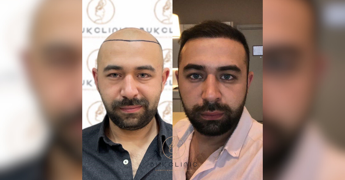 top  best hair transplant turkey istanbul
