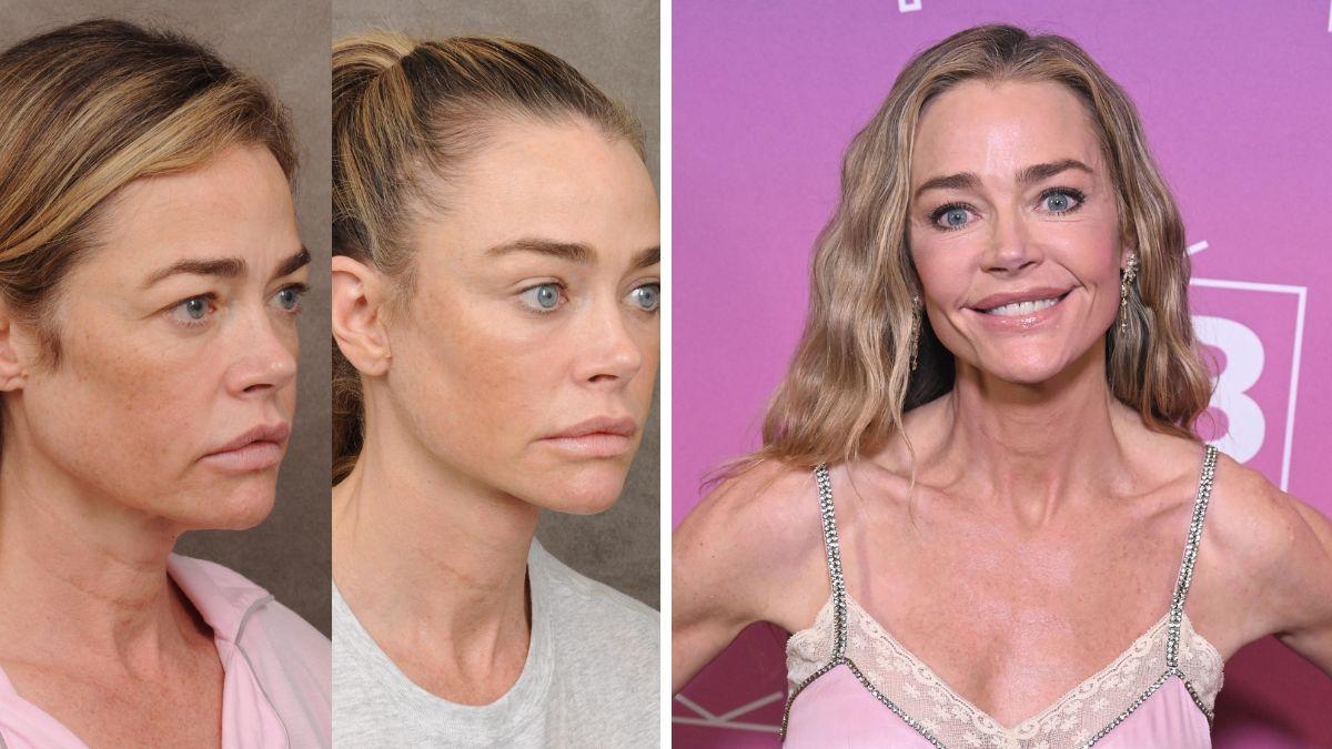 celebrities who got facelifts before after photos