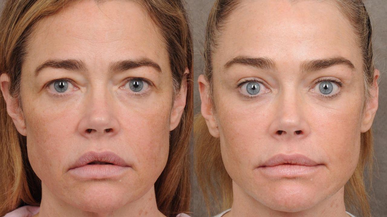 Denise Richards Details the ‘Roughest’ Part of Facelift Recovery After Undergoing Multiple Procedures