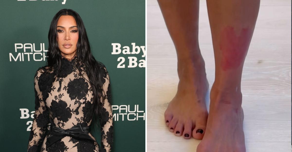 Kim Kardashian Struggling With 'Painful' Psoriasis Flare-Up: Photos