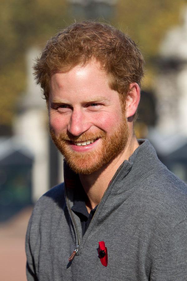 Prince harry hair plugs hair loss issues updates 04