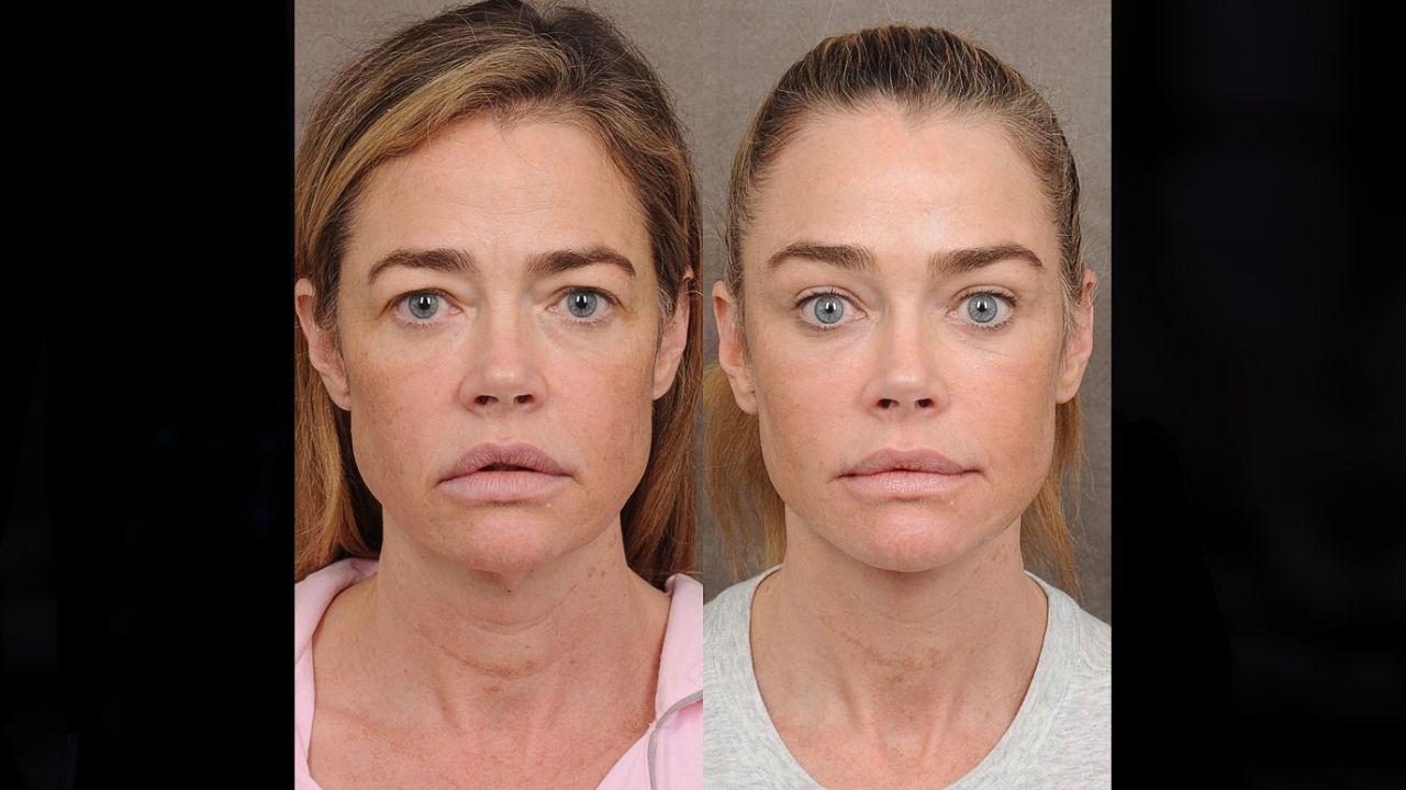 Image of Denise Richards before and after facelift.