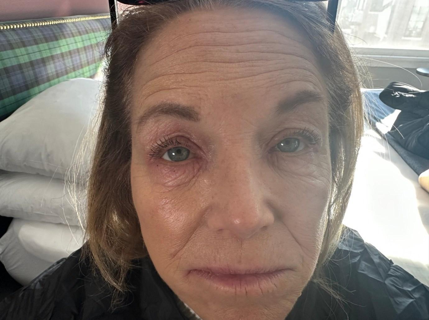 katie couric shows eczema flare up makeup free face picture