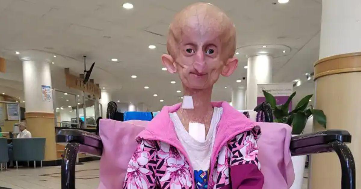 tiktok beandri booysen dead  rare premature aging disease