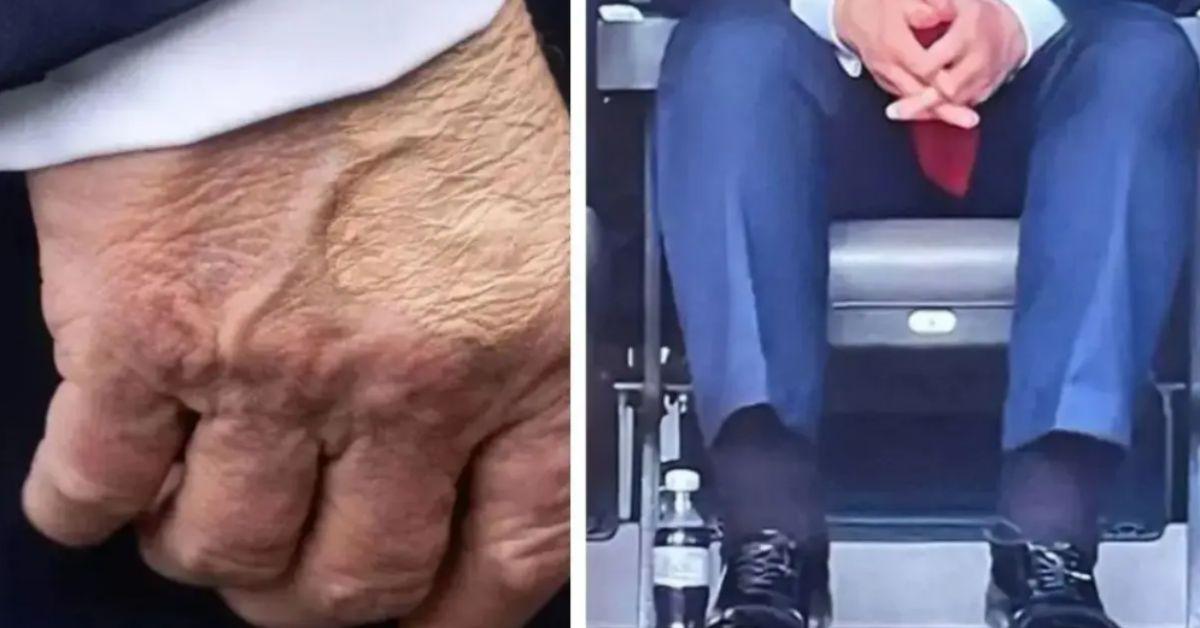 image of Donald Trump frequently covers his bruises with makeup. 