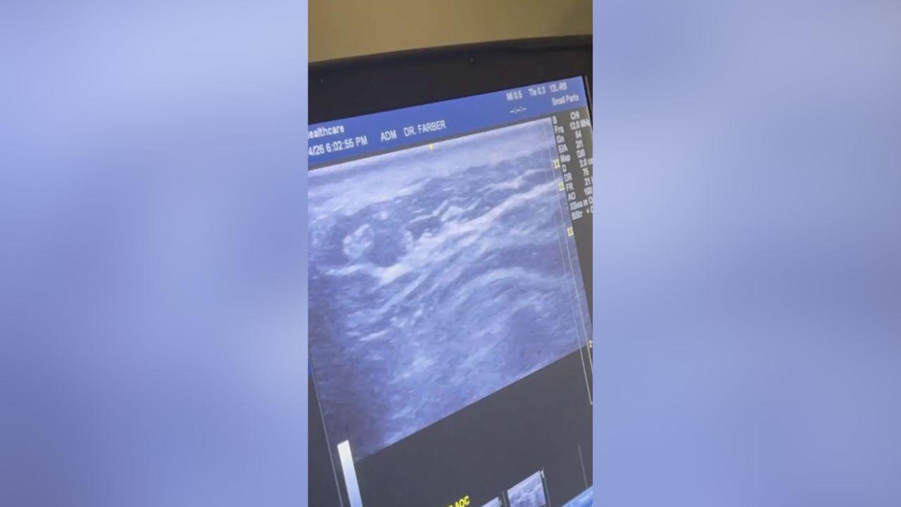 Image of Her routine now includes roughly 18 hours of IV infusions a day, with a home nurse visiting each evening, leaving her mostly housebound.