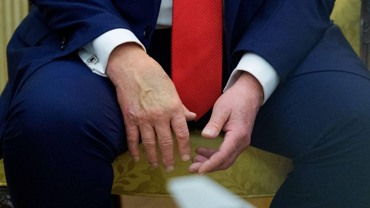 Image of Visible bruises on his hands drew public attention.