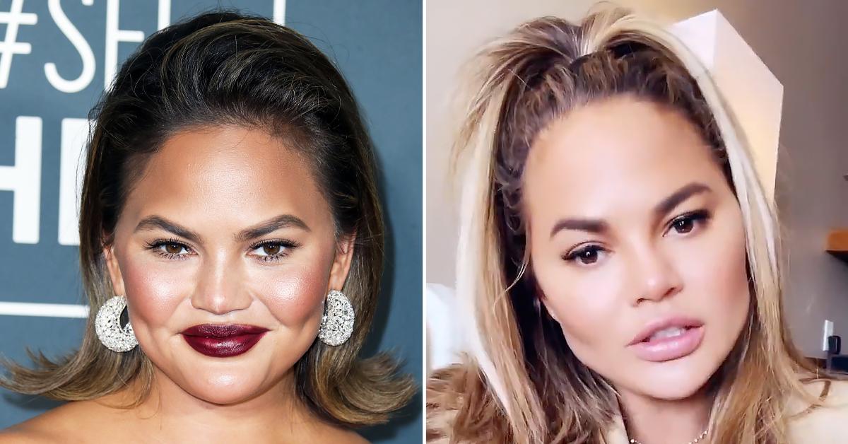 chrissy teigen surgery fat removal cheeks ok