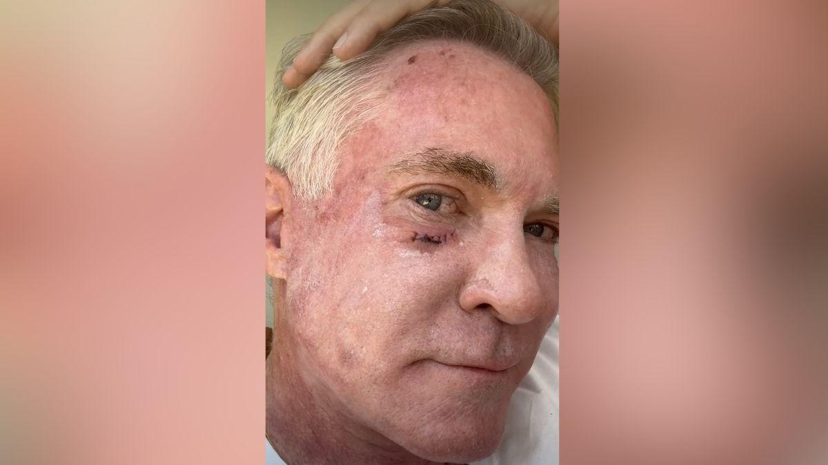 Image of Sam Champion was treated for skin cancer.