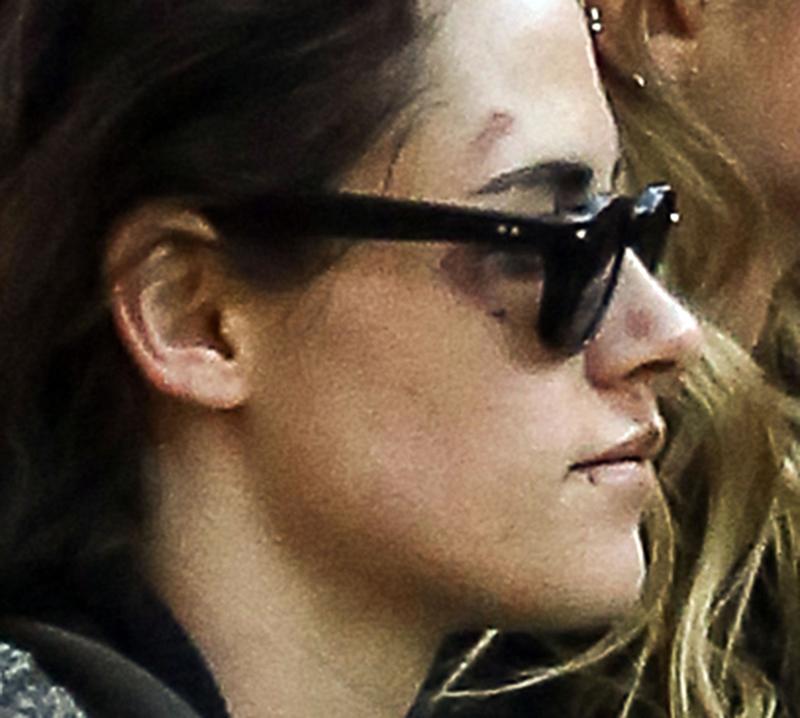 Exclusive&#8230; Premium: Bruised Up Kristen Stewart Enjoys Savannah With Girlfriend Stella Maxwell  ***NO USE W/O PRIOR AGREEMENT &#8211; CALL FOR PRICING***