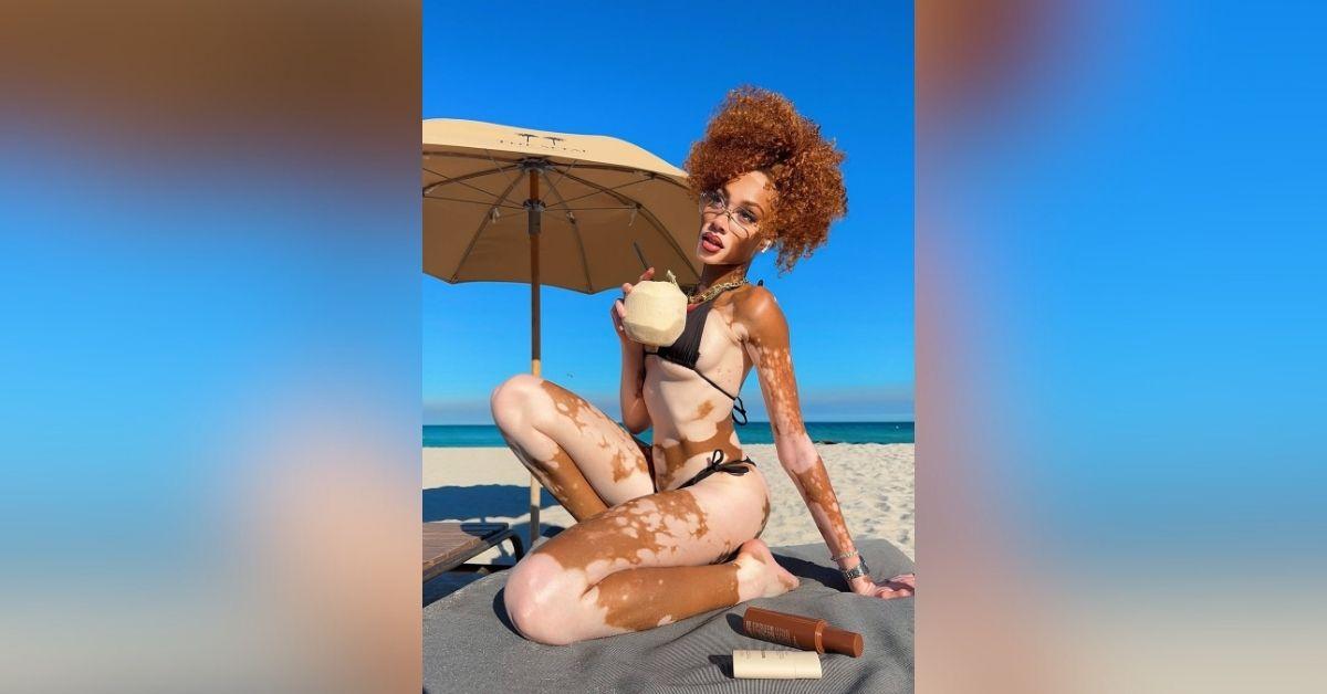 winnie harlow modeling vitiligo story