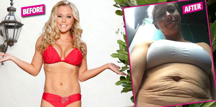 kendra wilkinson stretch marks