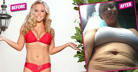 kendra wilkinson stretch marks