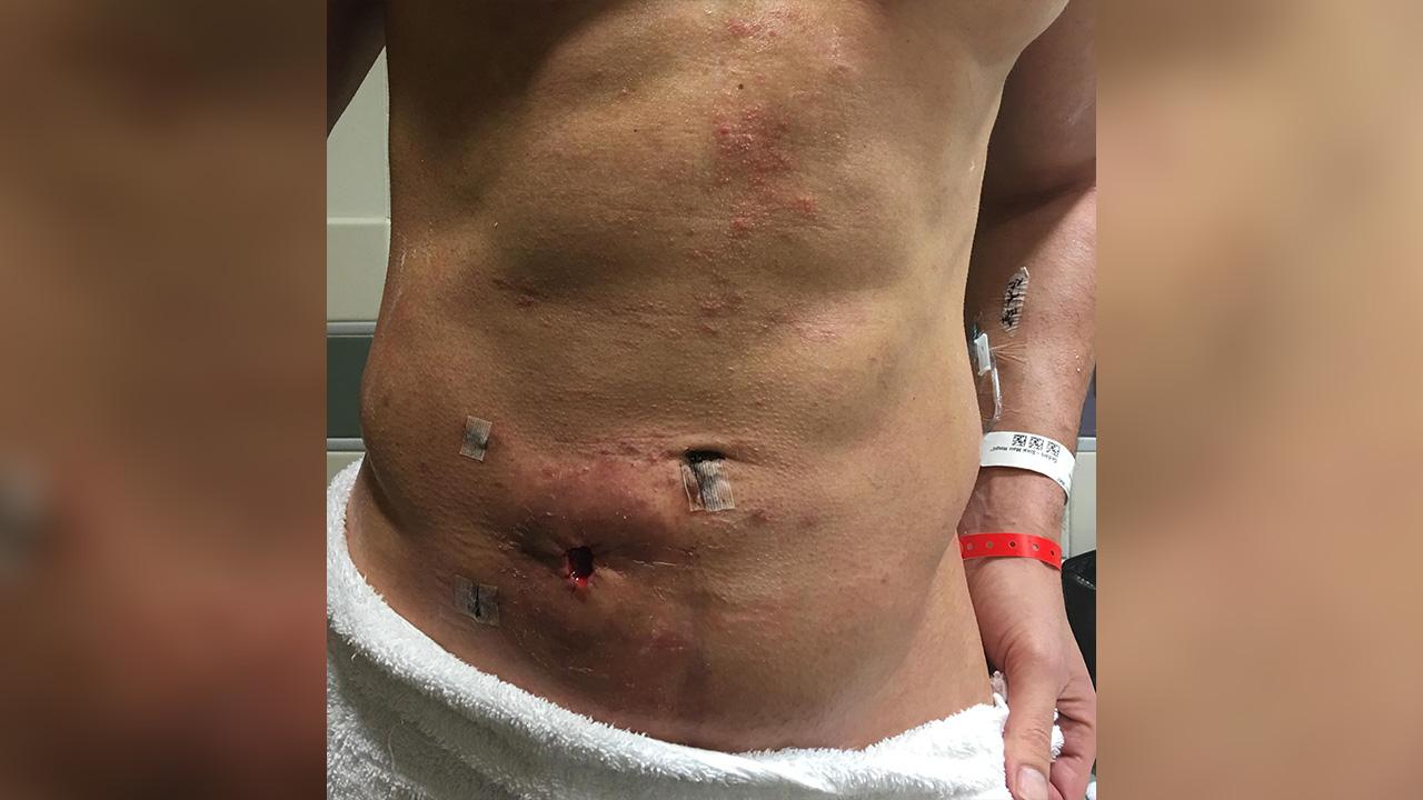 Image of Joe Manganiello was given an ostomy bag.