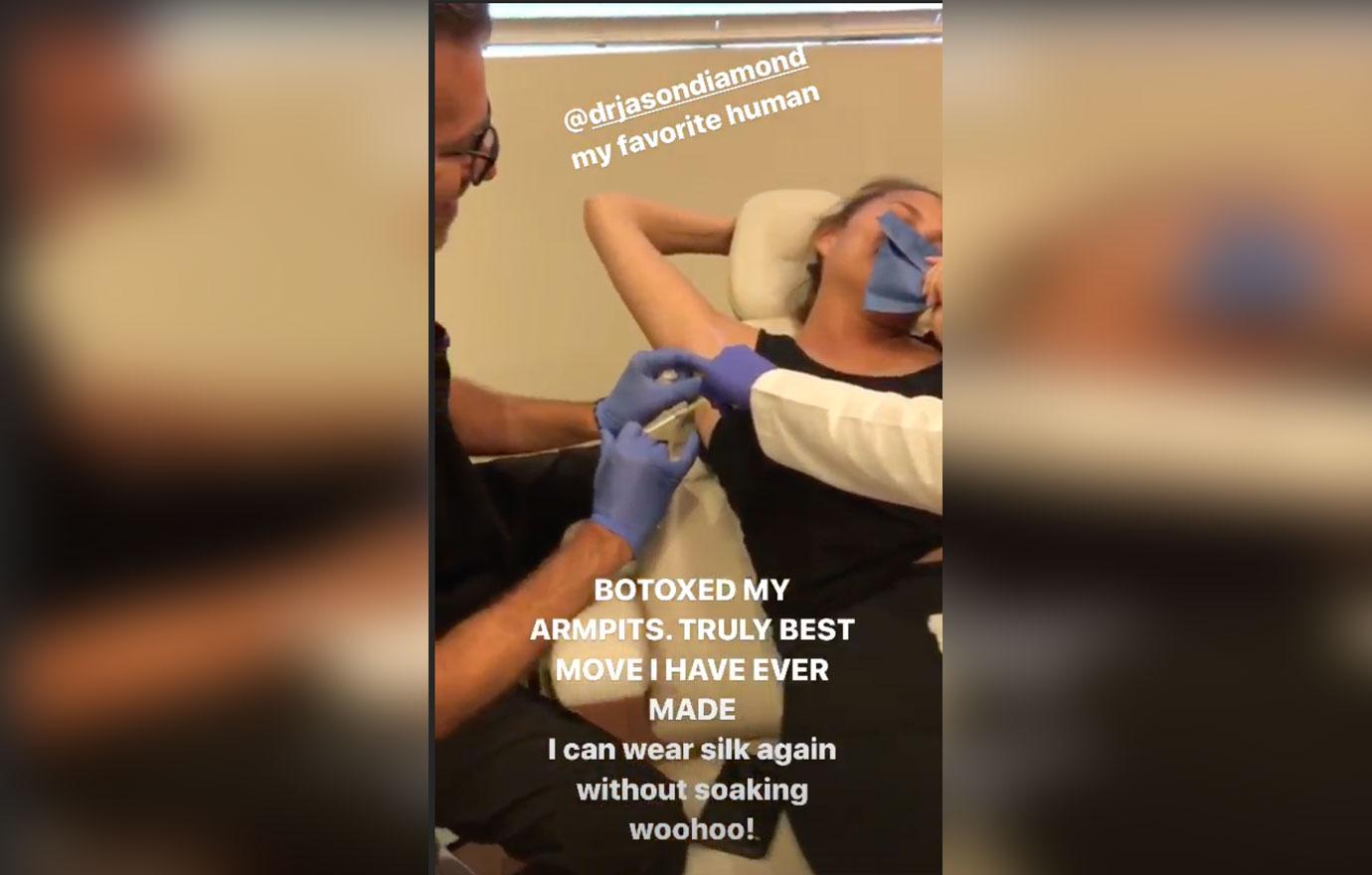 Chrissy Teigen Botox Armpits