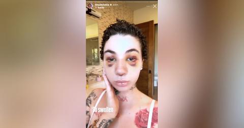 Bhad Bhabie Reveals Her Nose Job & Bruising In Candid Photo