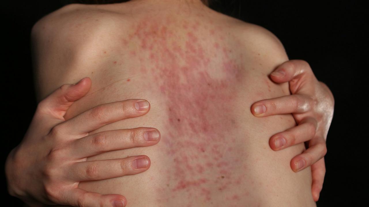 Photo of Viola Davis recalled thinking the rash was due to the bite of a poisonous spider.
