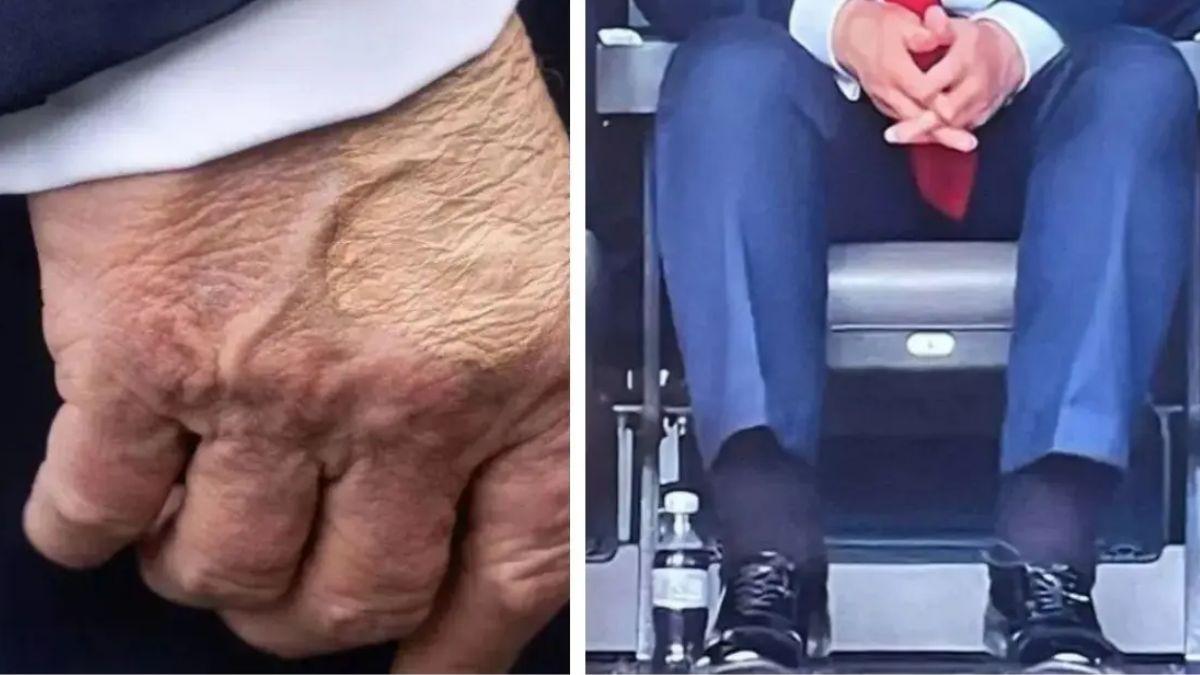 image of The president was diagnosed with chronic venous insufficiency, which is believed to cause the swelling.